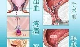 女性混合痔疮手术视频,女性混合痔疮手术过程解析与康复指导